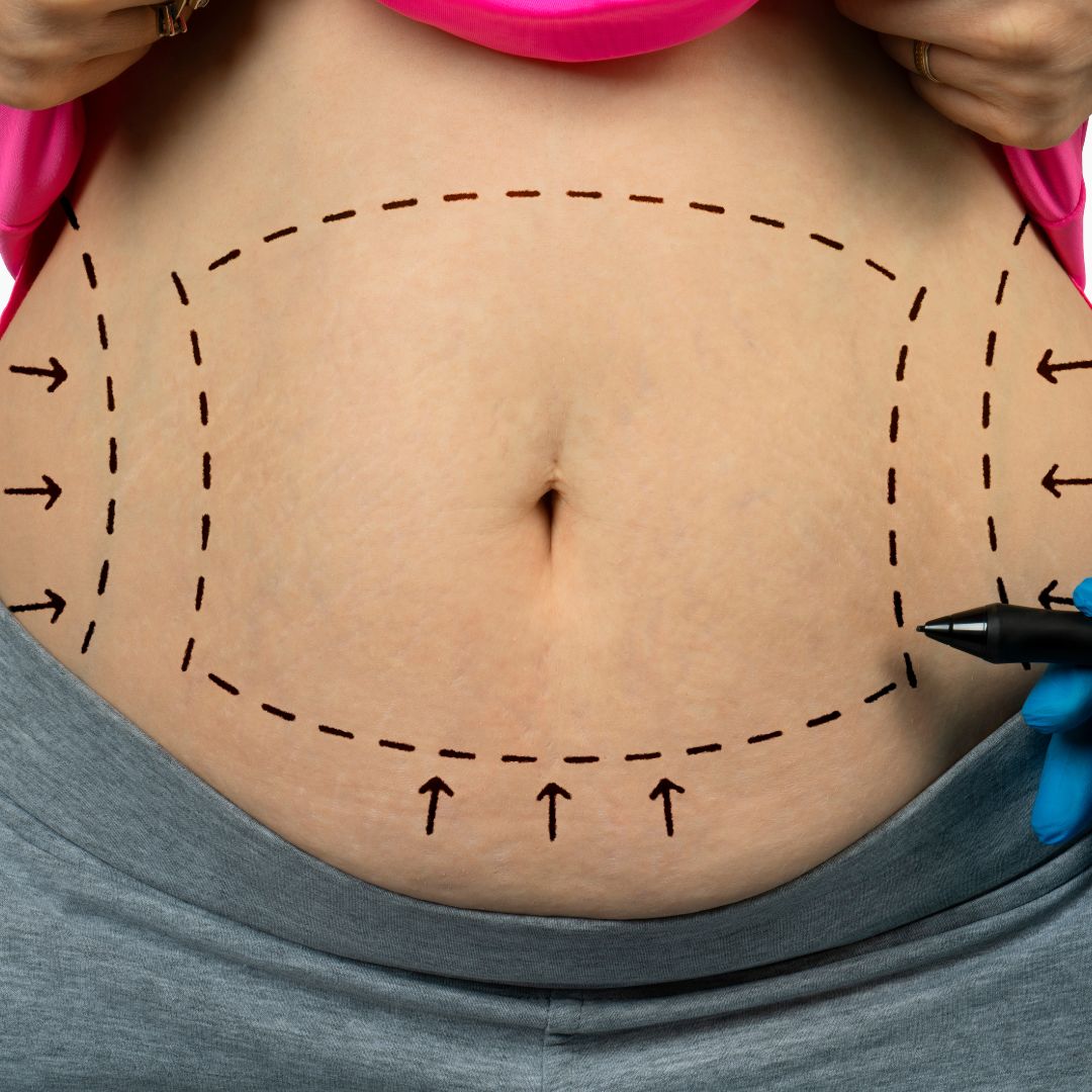 Imagem de fundo do post Abdominoplastia é um procedimento seguro?